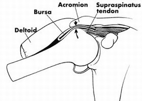 Az acromion �s humerus csontok k�z�tt �sszenyom�dik a ny�lkat�ml� �s a supraspinatus �n