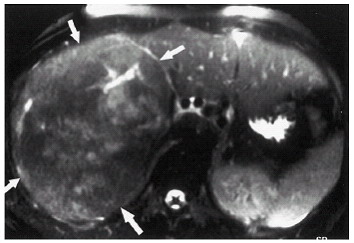 Hepatocellul�ris adenoma a m�jban