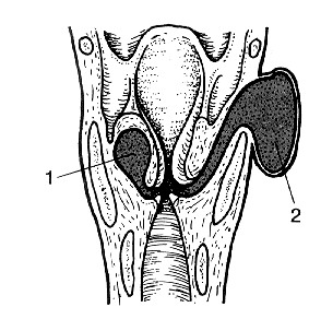 Laryngokele