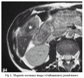 A gyullad�sos pszeudotumor MRI k�pe