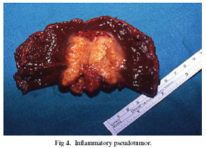 Gyullad�sos pszeudotumor